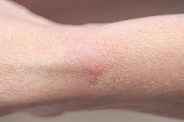 济南频现飞行隐翅虫现象探秘